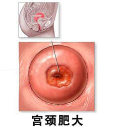 女性存在宫颈肥大的病因